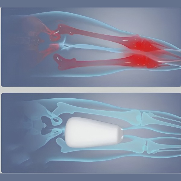 ORTHOPILLOW trykaflastning